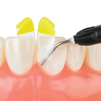 Model smile with fixed bridge restoration