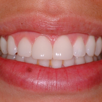 Two animated dental implants