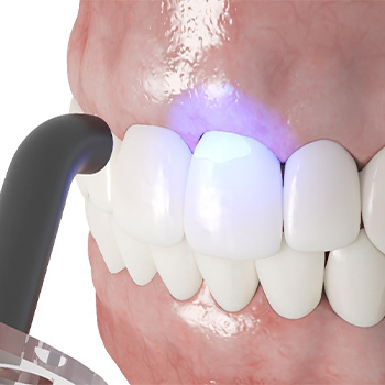 An illustration of cosmetic dental bonding in Hampton