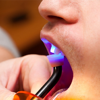 A dentist performing cosmetic dental bonding in Hampton 