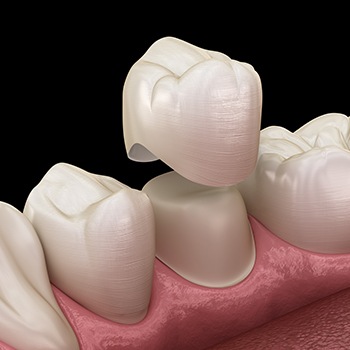 Animation of dental crown placement