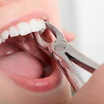 Dentist using forceps to perform simple extraction 