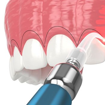 Illustration of dental laser being used for gum recontouring