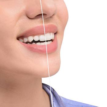 Close-up of woman’s smile before and after gum recontouring