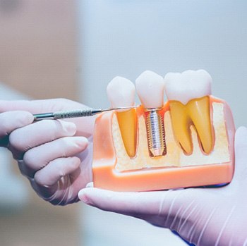 Dentist pointing to a dental implant model