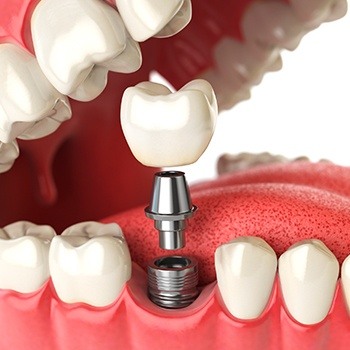 dental implant post, abutment, and crown being placed in the mouth