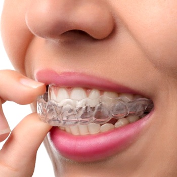 person inserting Invisalign aligner