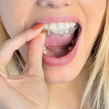 blonde woman inserting Invisalign clear aligner