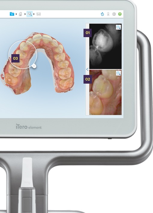 iTero Element 5D in Hampton connected to laptop computer