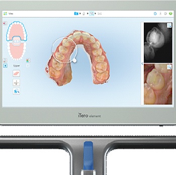 Monitor showing scans taken by the iTero Element 5D