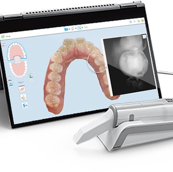 Image of scanned teeth as part of orthodontic preparation