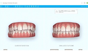 Simulated Invisalign outcome produced by iTero Element 5D