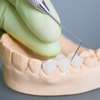 Model smile with fixed bridge restoration