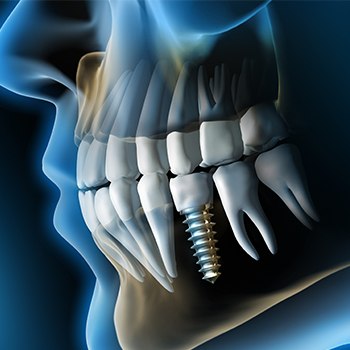 Animation of implant supported dental crown