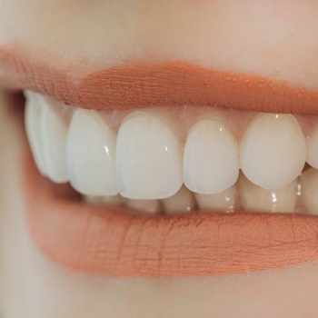 close up smile after teeth whitening in Hampton