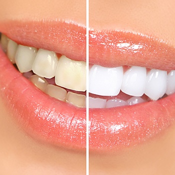 Patient's teeth before and after teeth whitening