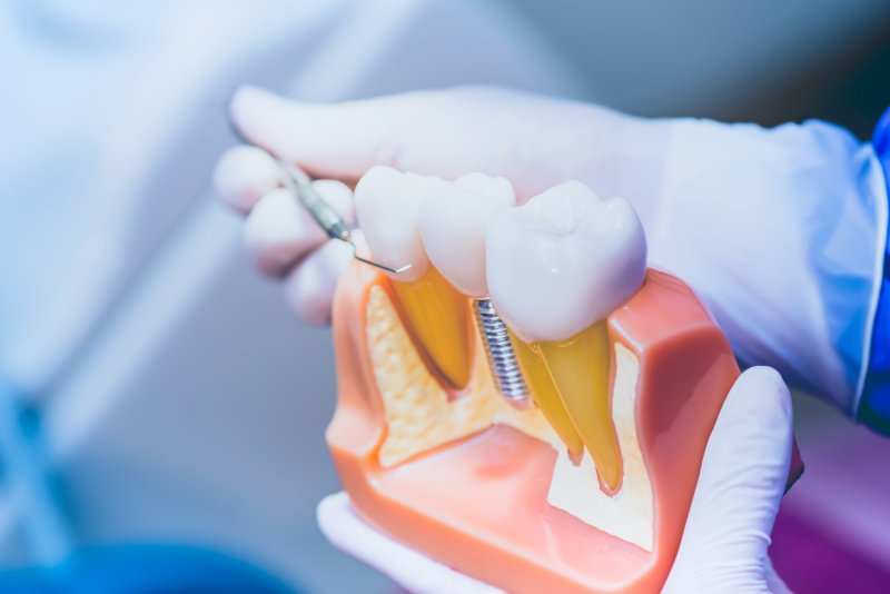 Model of dental implants in Hampton