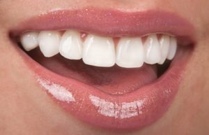 Woman smiling with top row of teeth showing